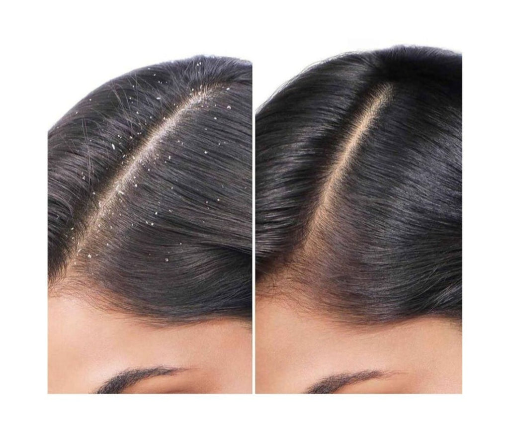 Hair Pro Care Anti-Dandruff Tea Tree Shampoo & Conditioner Sulphate Free 300ml